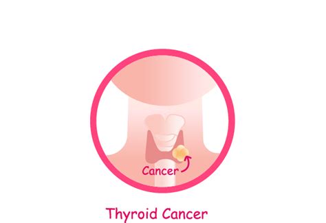 Thyroid Cancer Symptoms, Diagnosis, Surgery, Treatment, and Prognosis | Saint John’s Cancer ...