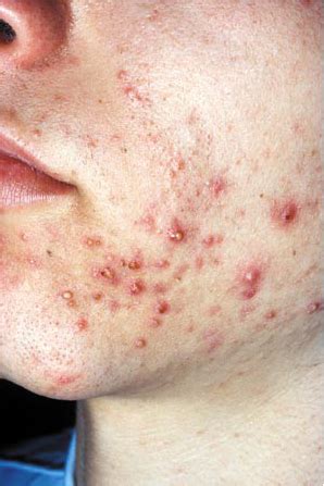 Images of Adult Acne & effective treatments - Acne-Ltd III