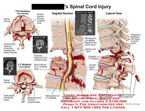 AMICUS Illustration of amicus,injury,t9,t10,t11,t12,l1,l2,spinal,nerves,midline,fracture ...