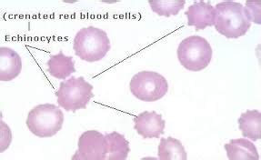 ECHINOCYTES (a common anomaly seen in live blood analysis)