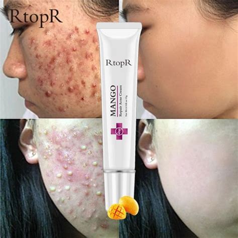 RtopR Acne Treatment Anti Acne Cream Scar Removal Cream @ Best Price Online | Jumia Kenya