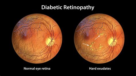 Diabetic Retinopathy (Symptoms, Causes & Treatment)