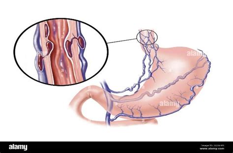 Esophageal varices grade III: A case report - Kauvery Hospital