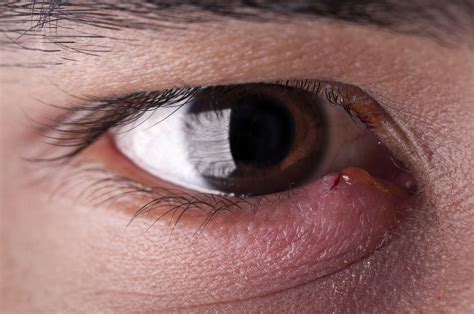 Bump on the Eyelid: Types, Symptoms, Causes, Treatment