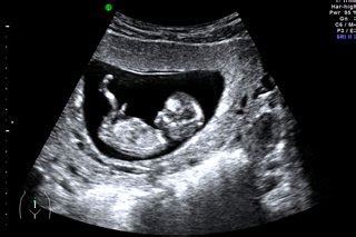 dating scan at 8 weeks