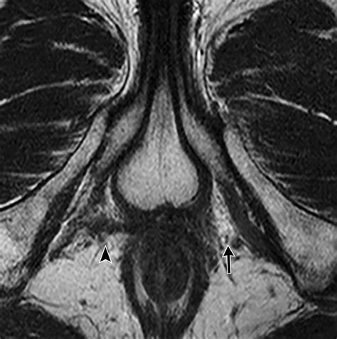 MRI of the Male Pelvic Floor | RadioGraphics