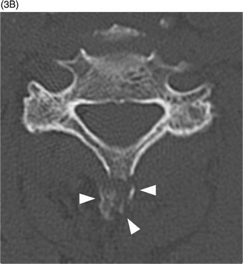 Lumbar Spinous Process Fracture