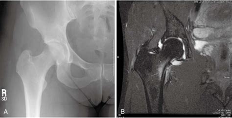 Stress Fractures of the Femoral Neck and Shaft | Musculoskeletal Key