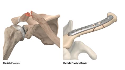 Clavicle Fractures | Dr. Edward S. Chang, MD