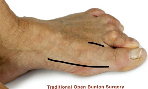 Minimally Invasive operation - Percutaneous Hallux Valgus (Bunion) - Clínica San Román