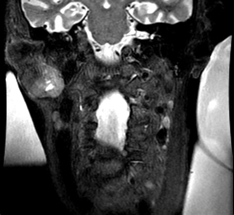 Pleomorphic adenoma - wikidoc