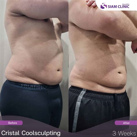 Cristal Cryolipolysis result - Siam Clinic - Aesthetic & Wellness Clinic in Phuket