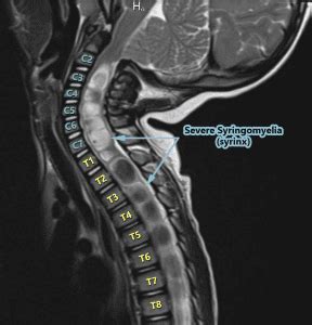 From The Inside Out - Understanding Syringomyelia & Syringobulbia - Chiari Bridges