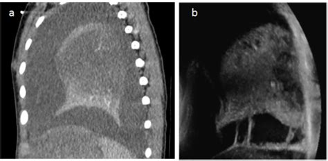 (a) Chest CT with contrast agent injection in a 2.5-year-old child with ...