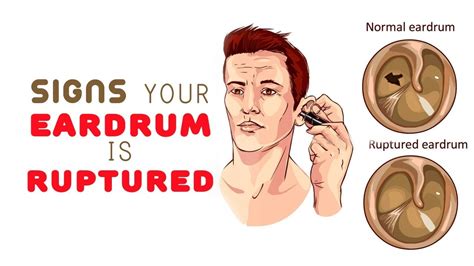 8 Signs Your Eardrum is Ruptured - YouTube