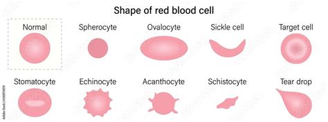 Red blood cell morphology. Shape of red blood cell. Spherocyte, Ovalocyte, Sickle cell, Target ...