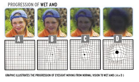 Wet Amd Vision