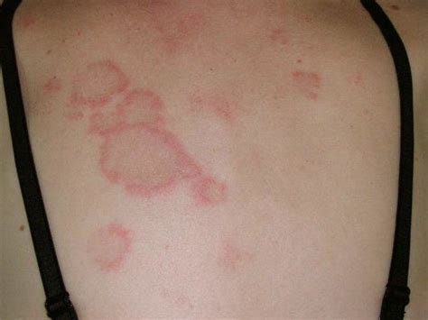 cutaneous lupus erythematosus pictures 3 | Subacute cutaneous lupus ...