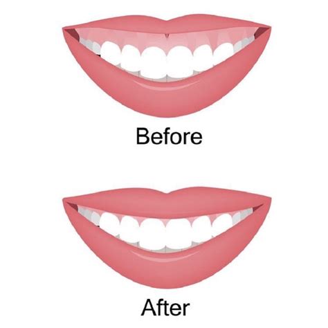 Gummy Smile Botox: What You Need To Know