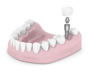 Dental Implants Houston TX | Best Dental Implants Houston | Implant ...