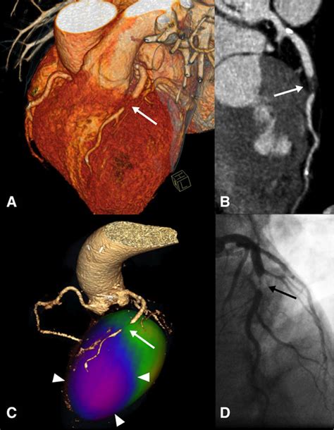 Coronary Artery Computed Tomography Scanning | Circulation