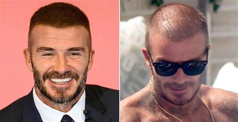 Celebrities with Hair Transplant: Elon Musk and David Silva - RepHair