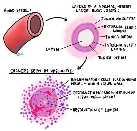 Vasculitis | MyPathologyReport.ca