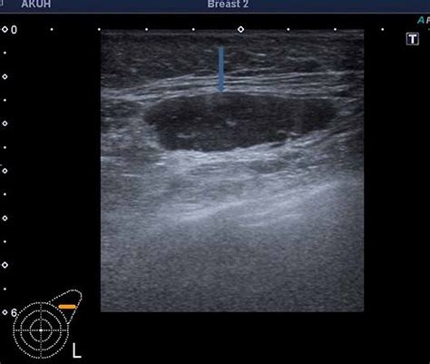 Cureus | Preoperative Ultrasound-guided Core Biopsy of Axillary Nodes for Staging of Clinically ...