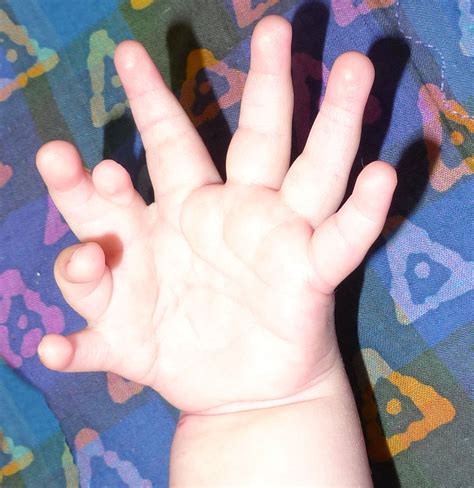 Limb Formation | Congenital Hand and Arm Differences | Washington University in St. Louis