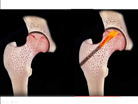 Avascular Necrosis of the Femoral Head — OrthopaedicPrinciples.com