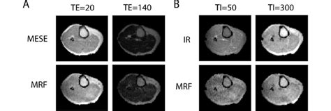 Synthetic MRI images of a volunteer's lower leg obtained with MRF and ...