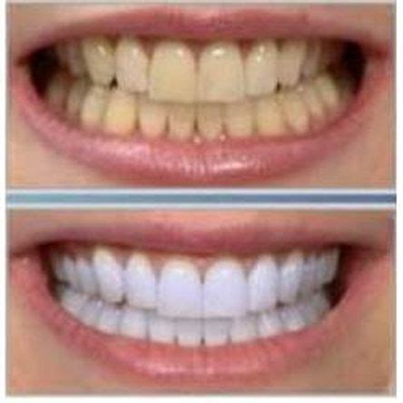 Blanqueamiento dental casero