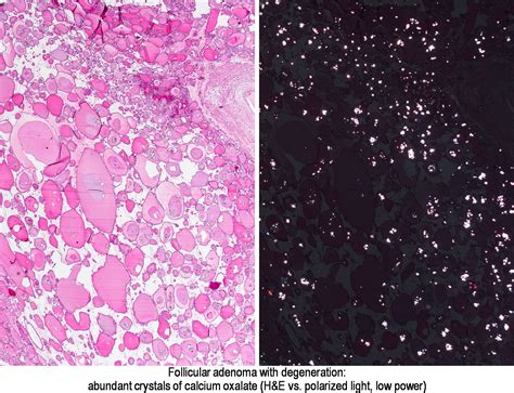 Pathology Outlines - Calcification