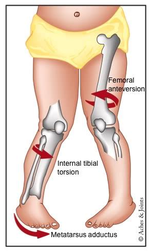 In-toeing (Pigeon Toes) | Causes and Treatment | Dr. Jarman