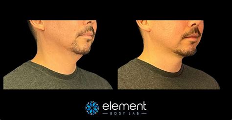 Chin CoolSculpting in Dallas, TX | Element Body Lab