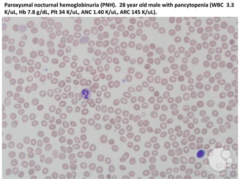 Paroxysmal nocturnal hemoglobinuria (PNH) Peripheral smear