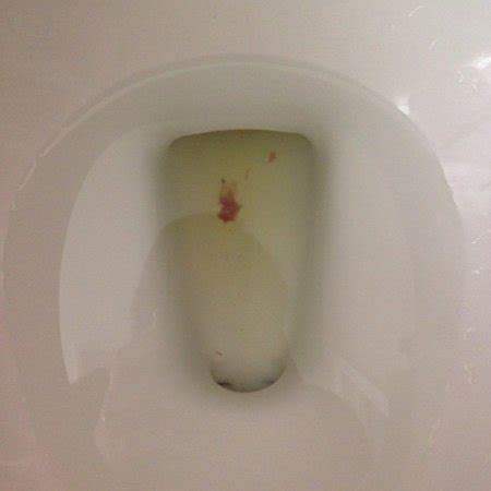 Tissue in urine, please help. PICTURE is a little gross. | original ...