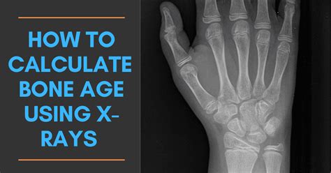 Calculating Bone Age Using X-rays [Includes AI-based Automated Tools ...