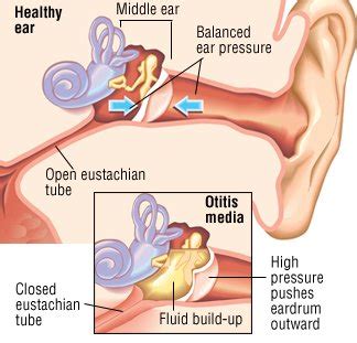 Middle-Ear Infection (Otitis Media) Guide: Causes, Symptoms and Treatment Options