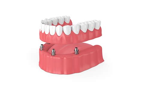 Implant-Supported Dentures