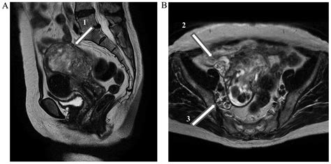 √ Uterus Endometriosis Ct Scan / Tumors Of The Uterine Corpus Clinical Gate : The best way to ...