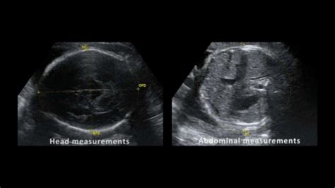 Ultrasound examination of the third trimester of pregnancy