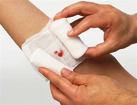 Perfect Way to Treat Wounds at Home - lifeberrys.com