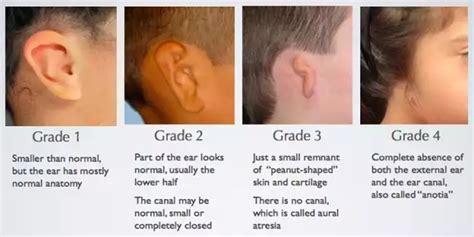 Microtia/Atresia | Dr. Duane Mol