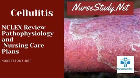 Cellulitis Nursing Care Plans and Diagnosis Interventions - NurseStudy.Net