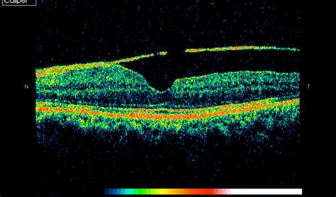 Macular Pseudohole - OCT - Retina Image Bank