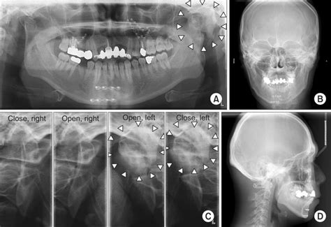 Preoperative radiography (Case 2). The lesion of fibrous and bony ...