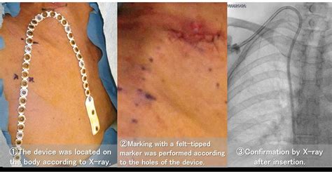 Okayama University Research: New Device for Assisting Accurate Hemodialysis Catheter Placement