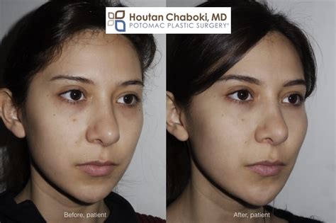 Fill Flat Cheeks with Facial Fillers