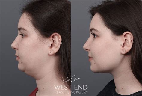 Buccal Fat Reduction Washington DC | Cheek Fat Removal Washington DC